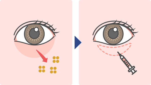 脱脂＋脂肪注入