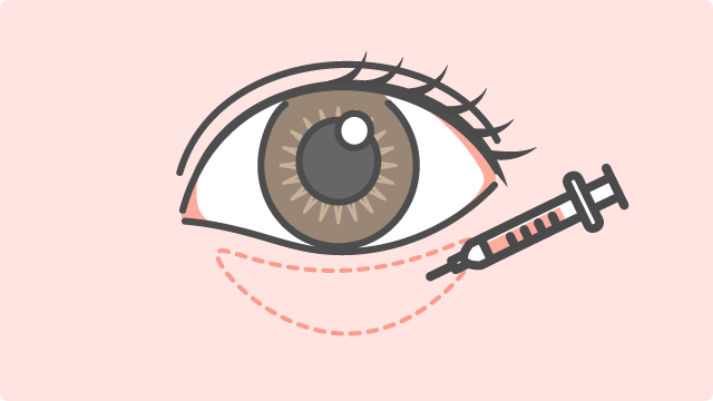 ヒアルロン酸注入